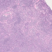 MALT lymphoma